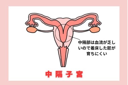 流産の原因の1つの中隔子宮を説明する図